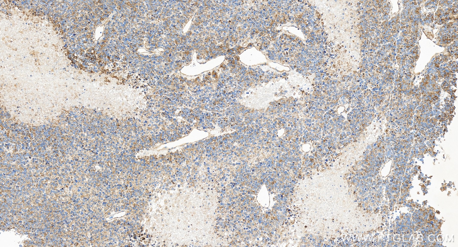 Immunohistochemistry (IHC) staining of human liver cancer tissue using Cytokeratin 18 Recombinant antibody (82817-5-RR)