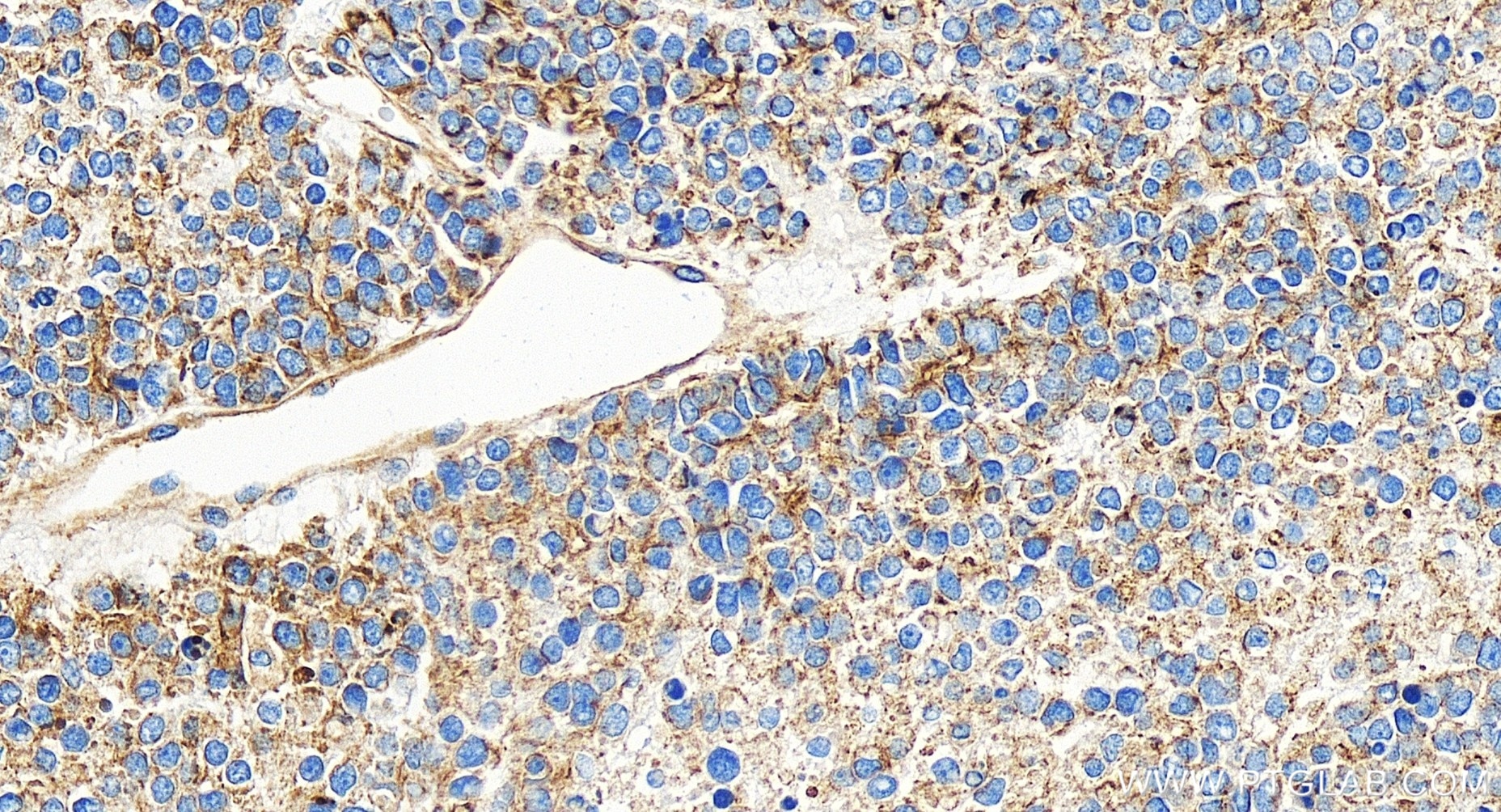Immunohistochemistry (IHC) staining of human liver cancer tissue using Cytokeratin 18 Recombinant antibody (82817-5-RR)