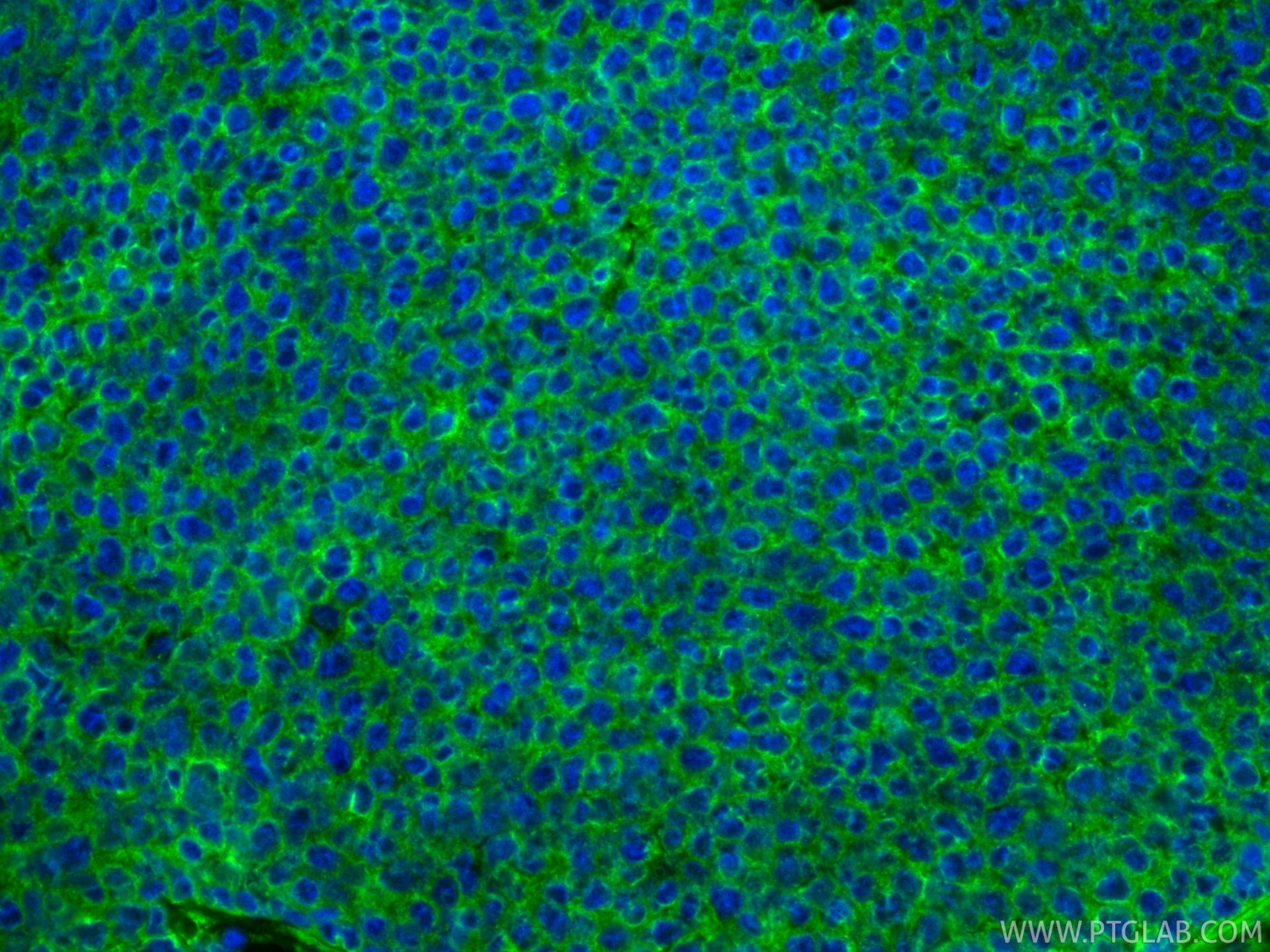 Immunofluorescence (IF) / fluorescent staining of human breast cancer tissue using Cytokeratin 18 Recombinant monoclonal antibody (82817-5-RR)