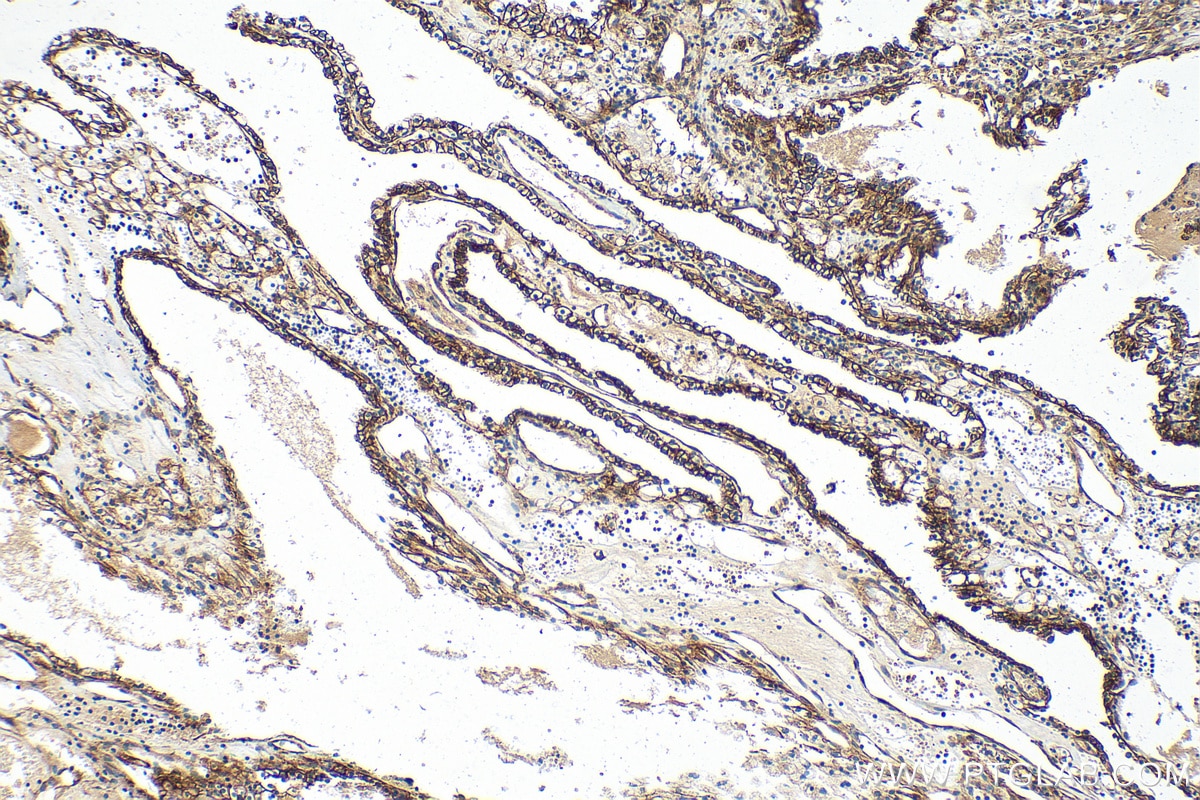 Immunohistochemistry (IHC) staining of human renal cell carcinoma tissue using Cytokeratin 18 Recombinant antibody (82817-5-RR)