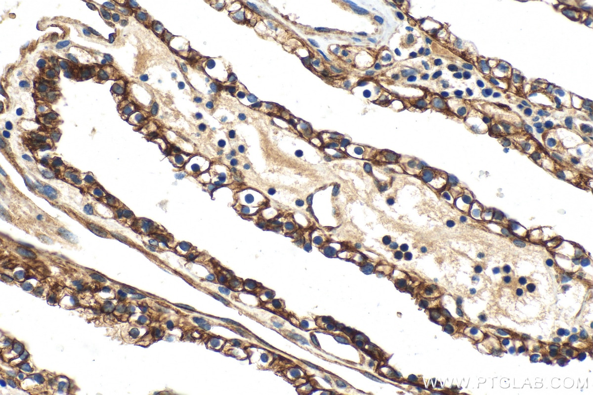 Immunohistochemistry (IHC) staining of human renal cell carcinoma tissue using Cytokeratin 18 Recombinant antibody (82817-5-RR)