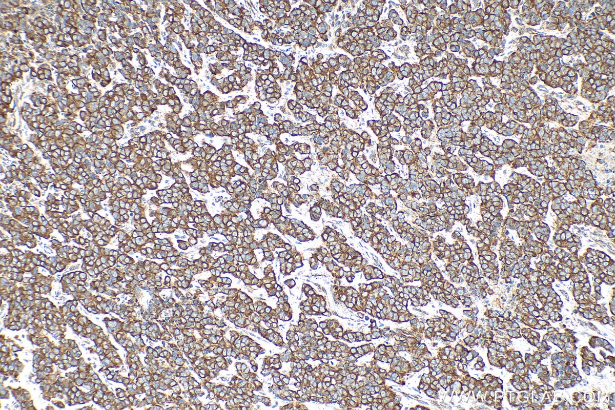 Immunohistochemistry (IHC) staining of human breast cancer tissue using Cytokeratin 18 Recombinant antibody (82817-5-RR)