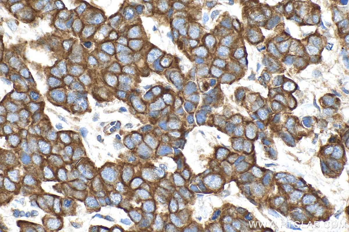 Immunohistochemistry (IHC) staining of human breast cancer tissue using Cytokeratin 18 Recombinant antibody (82817-5-RR)