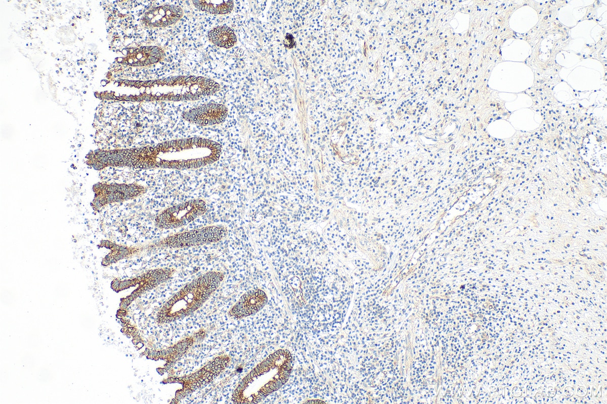 Immunohistochemistry (IHC) staining of human appendicitis tissue using Cytokeratin 18 Recombinant antibody (82817-5-RR)