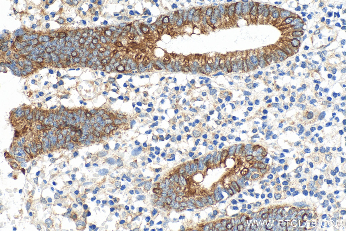 Immunohistochemistry (IHC) staining of human appendicitis tissue using Cytokeratin 18 Recombinant antibody (82817-5-RR)