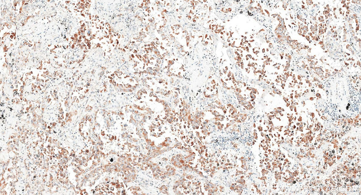 IHC staining of human lung cancer using 82817-5-RR Immunohistochemistry (IHC) staining of human lung cancer tissue using Cytokeratin 18 Recombinant monoclonal antibody (82817-5-RR)