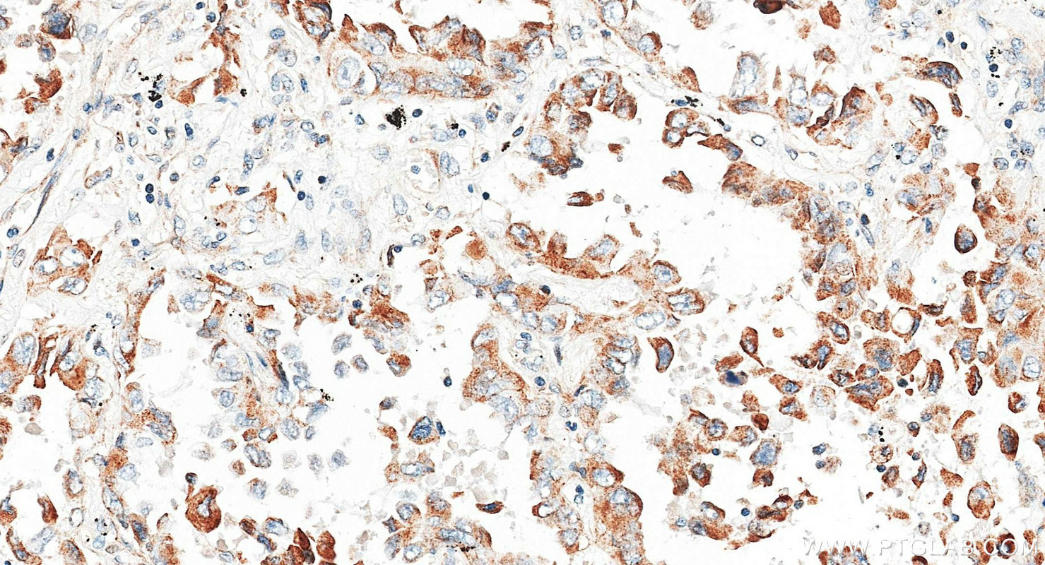 IHC staining of human lung cancer using 82817-5-RR Immunohistochemistry (IHC) staining of human lung cancer tissue using Cytokeratin 18 Recombinant monoclonal antibody (82817-5-RR)