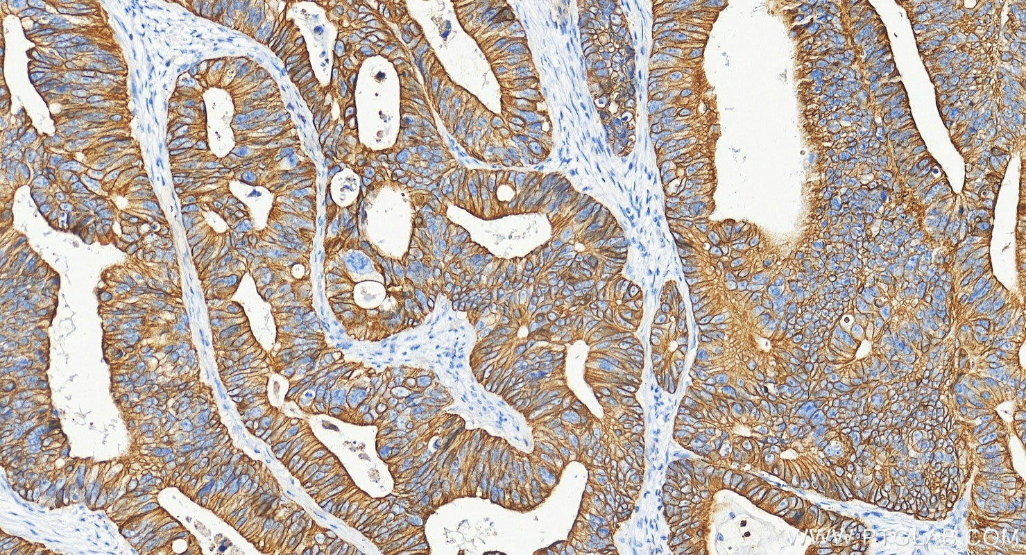 Immunohistochemistry (IHC) staining of human colon cancer tissue using Cytokeratin 19 Polyclonal antibody (10712-1-AP)