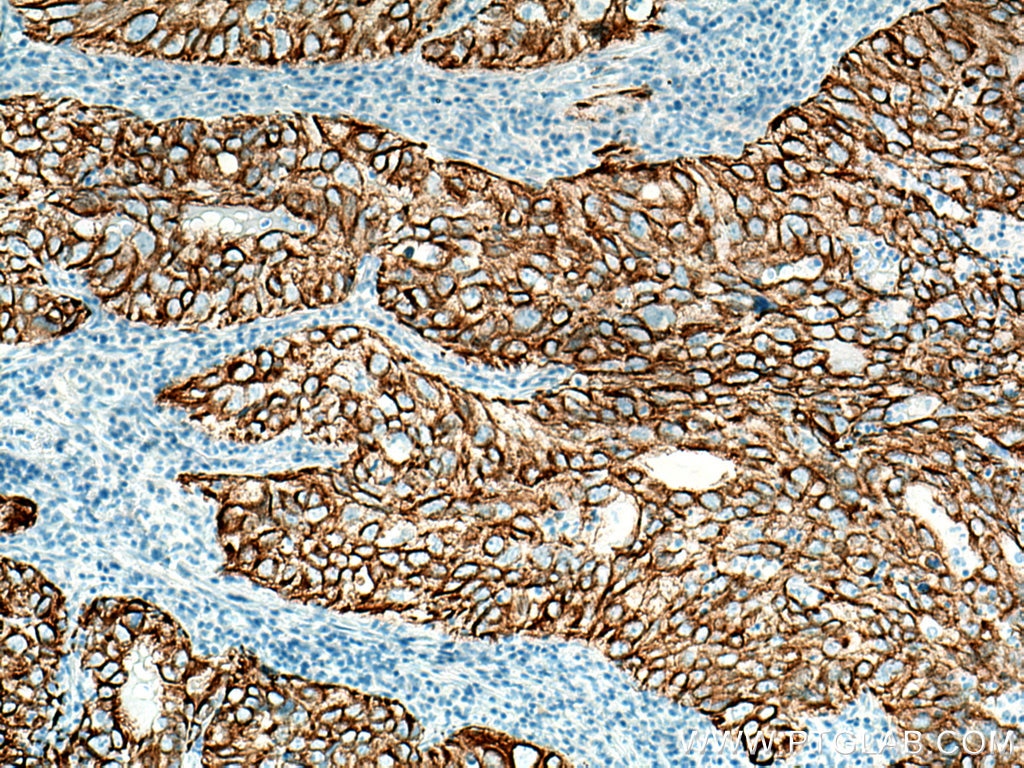 Immunohistochemistry (IHC) staining of human lung cancer tissue using Cytokeratin 19 Polyclonal antibody (10712-1-AP)