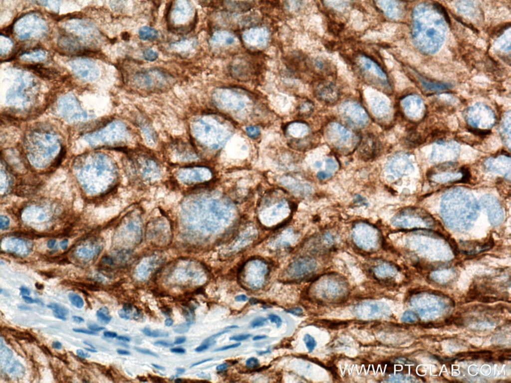 Immunohistochemistry (IHC) staining of human lung cancer tissue using Cytokeratin 19 Polyclonal antibody (10712-1-AP)