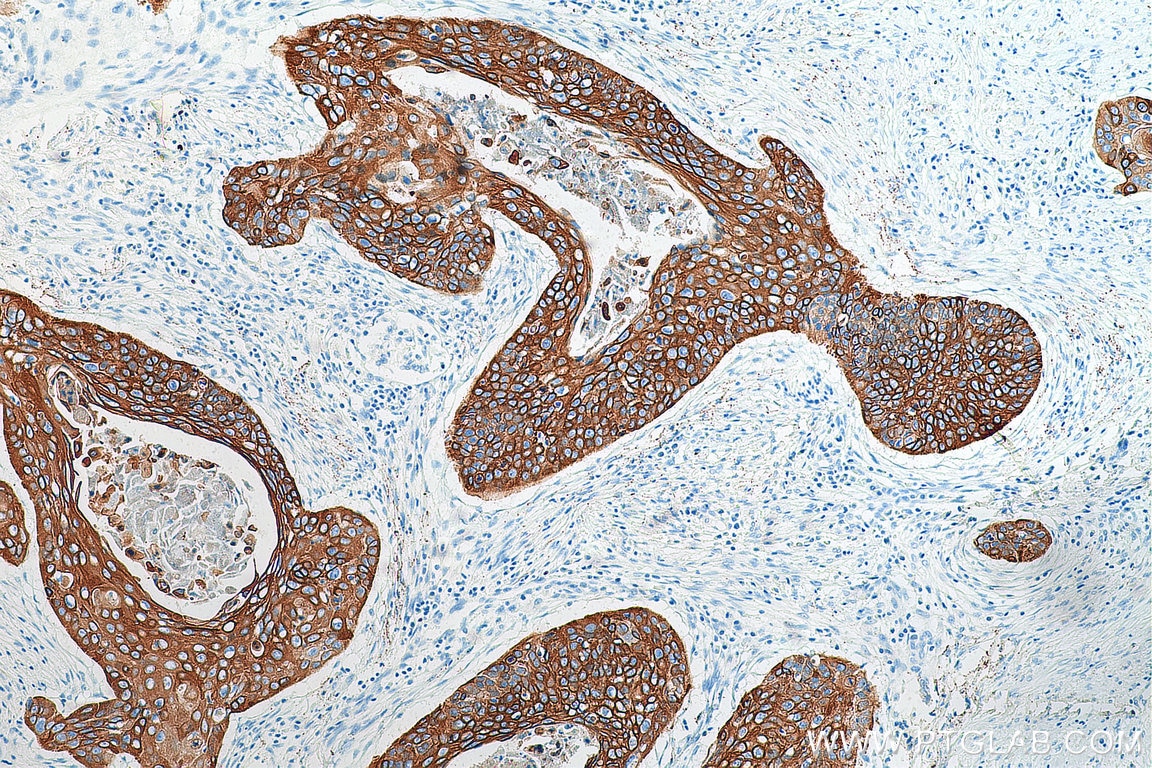 Immunohistochemistry (IHC) staining of human oesophagus cancer tissue using Cytokeratin 19 Polyclonal antibody (10712-1-AP)