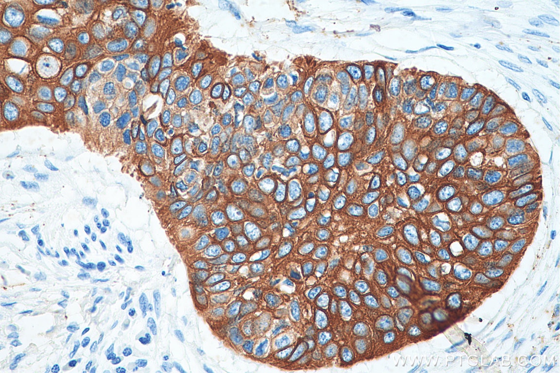 Immunohistochemistry (IHC) staining of human oesophagus cancer tissue using Cytokeratin 19 Polyclonal antibody (10712-1-AP)