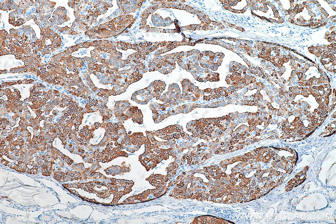 Immunohistochemistry (IHC) staining of human thyroid cancer tissue using Cytokeratin 19 Polyclonal antibody (10712-1-AP)