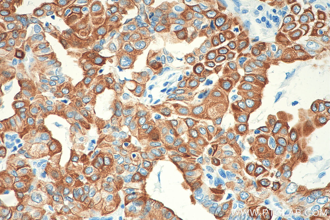 Immunohistochemistry (IHC) staining of human thyroid cancer tissue using Cytokeratin 19 Polyclonal antibody (10712-1-AP)