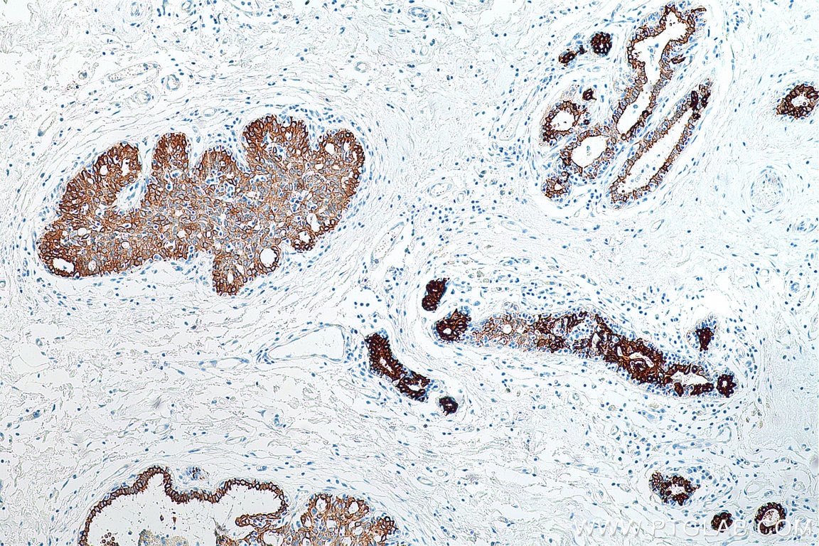 Immunohistochemistry (IHC) staining of human breast cancer tissue using Cytokeratin 19 Polyclonal antibody (10712-1-AP)