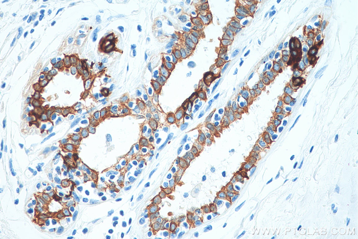 Immunohistochemistry (IHC) staining of human breast cancer tissue using Cytokeratin 19 Polyclonal antibody (10712-1-AP)