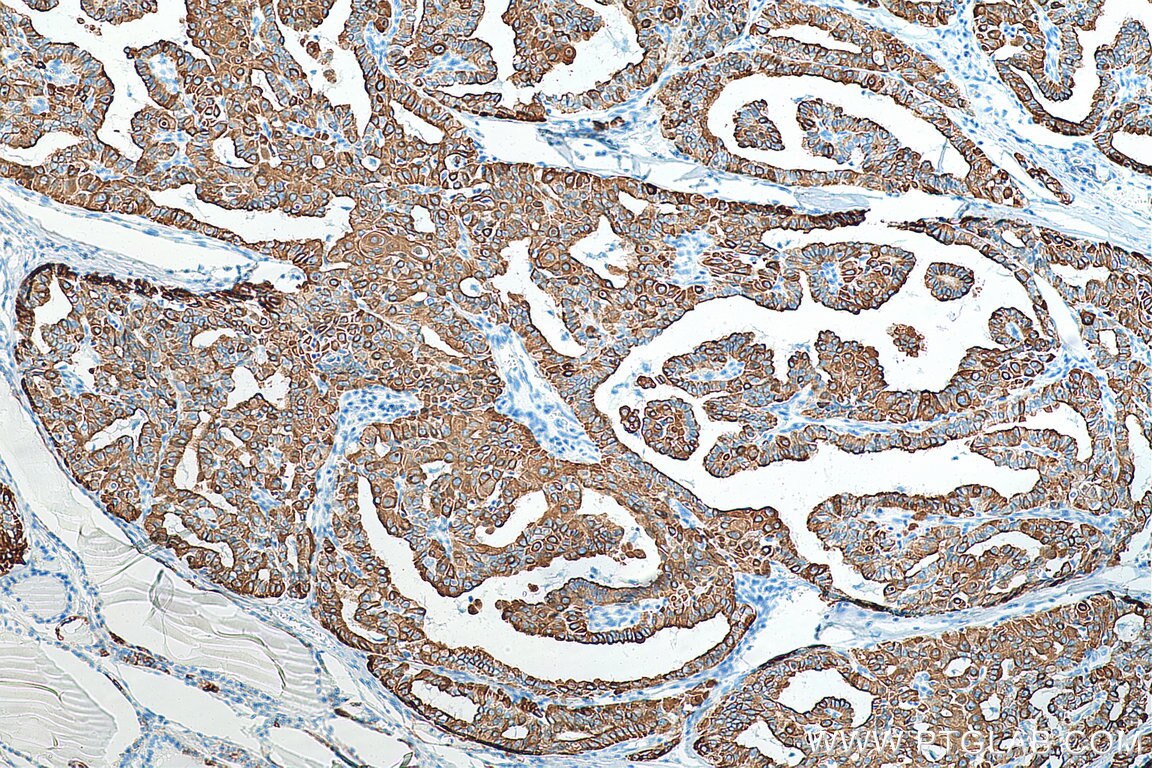 IHC staining of human thyroid cancer using 10712-1-AP