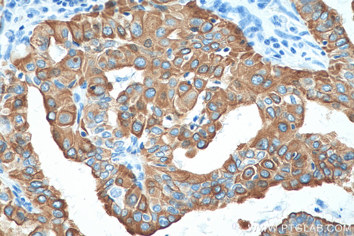 Immunohistochemistry (IHC) staining of human thyroid cancer tissue using Cytokeratin 19 Polyclonal antibody (10712-1-AP)