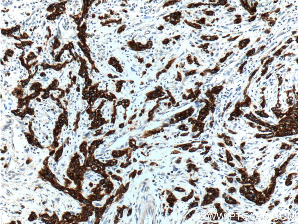 Immunohistochemistry (IHC) staining of human stomach cancer tissue using Cytokeratin 19 Polyclonal antibody (10712-1-AP)