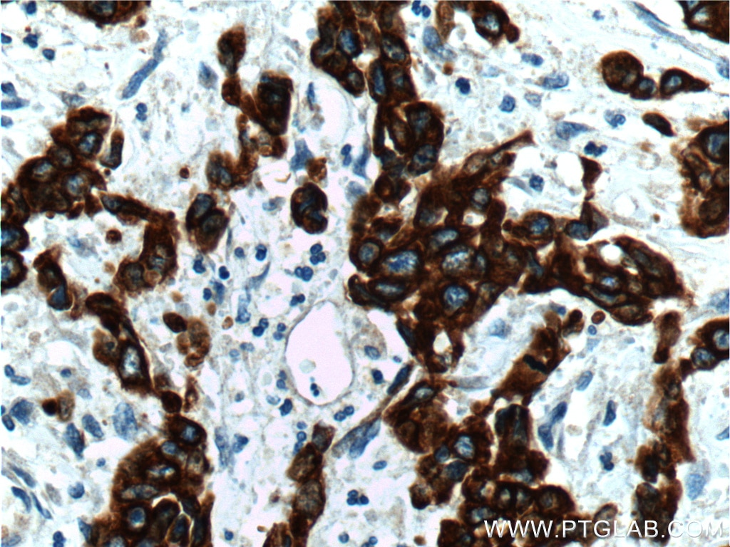 Immunohistochemistry (IHC) staining of human stomach cancer tissue using Cytokeratin 19 Polyclonal antibody (10712-1-AP)