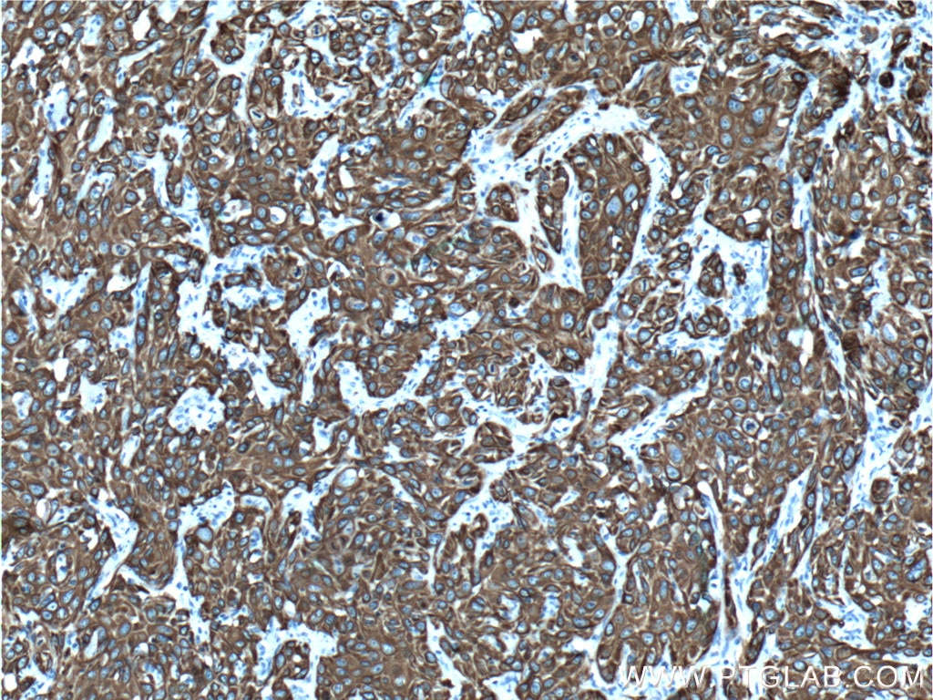 Immunohistochemistry (IHC) staining of human cervical cancer tissue using Cytokeratin 19 Polyclonal antibody (14965-1-AP)