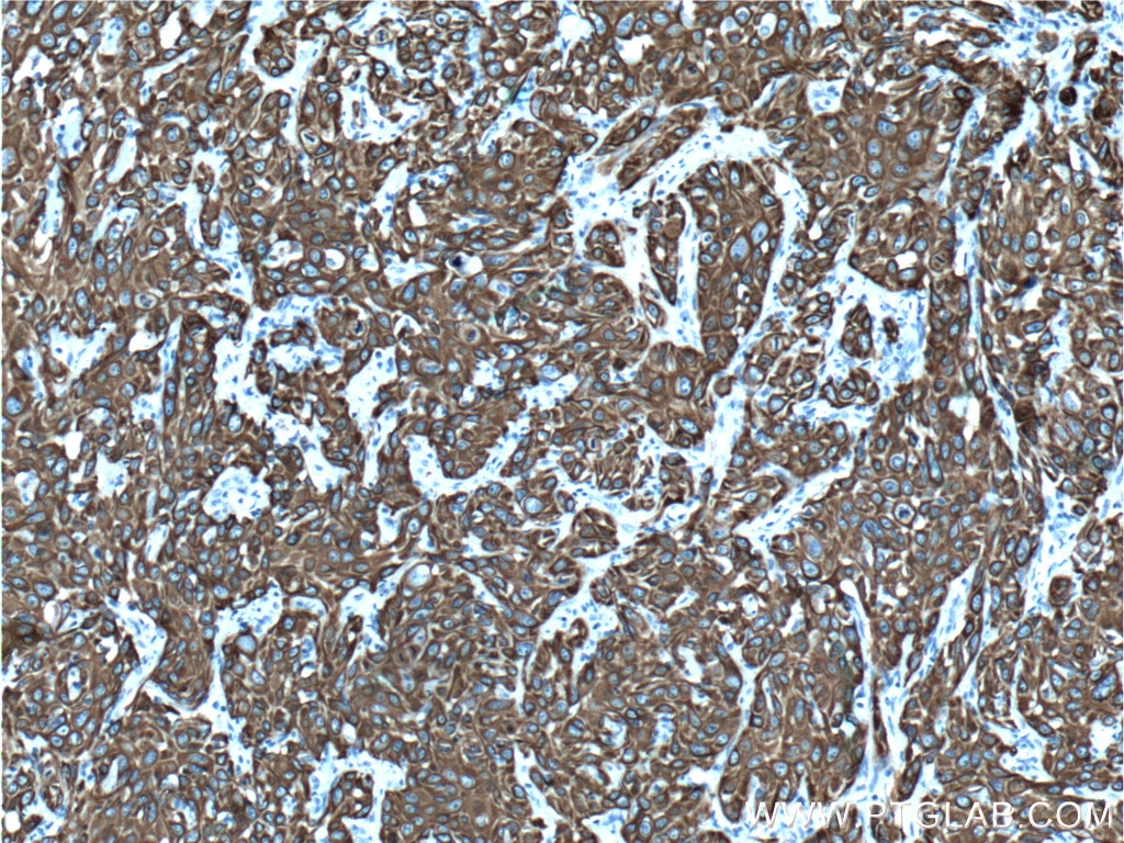 IHC staining of human cervical cancer using 14965-1-AP