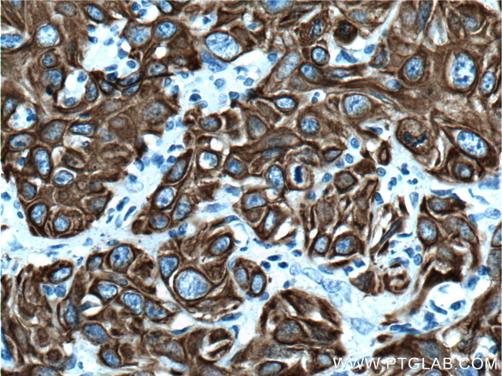 Immunohistochemistry (IHC) staining of human cervical cancer tissue using Cytokeratin 19 Polyclonal antibody (14965-1-AP)