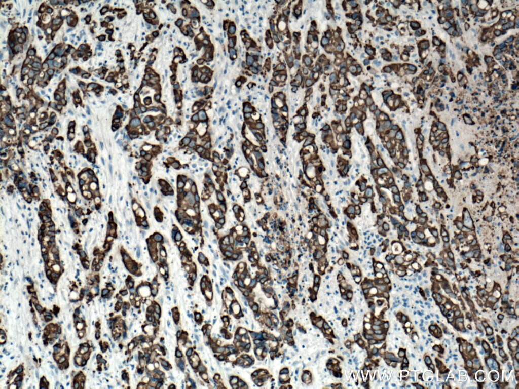 Immunohistochemistry (IHC) staining of human liver cancer tissue using Cytokeratin 19 Polyclonal antibody (14965-1-AP)