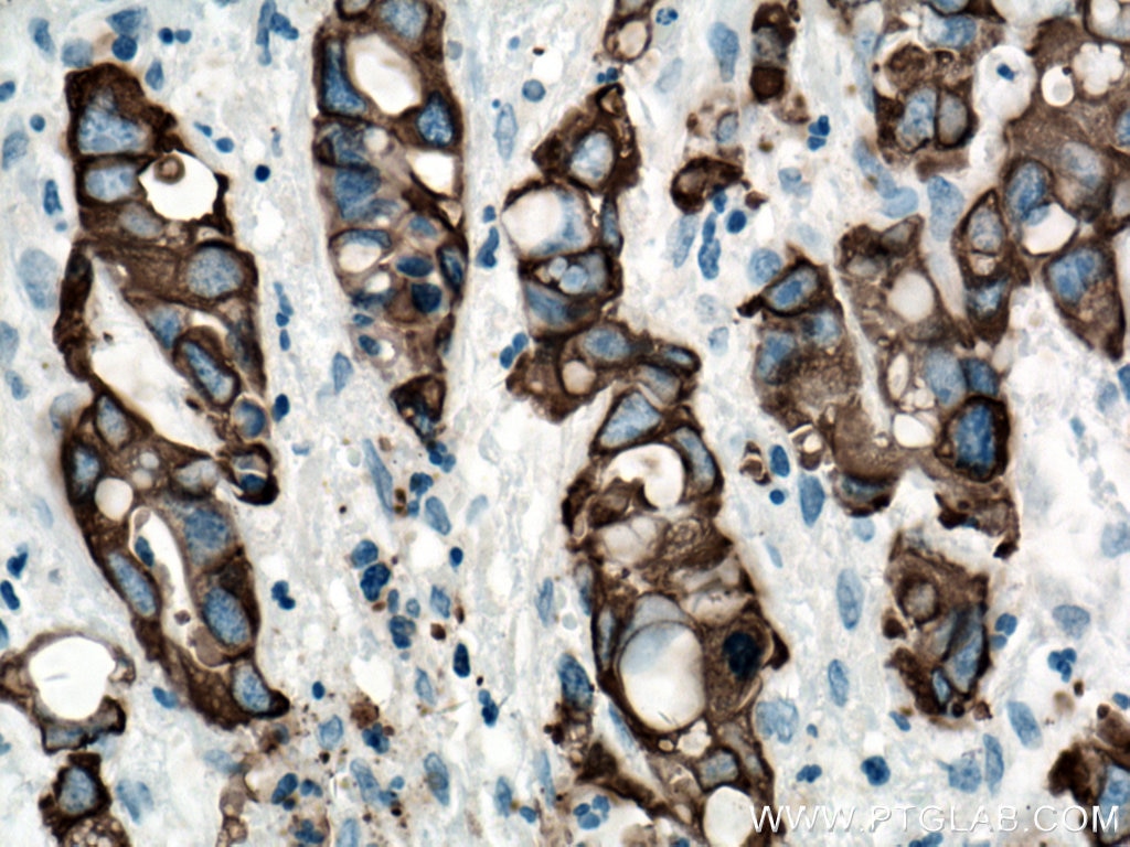 Immunohistochemistry (IHC) staining of human liver cancer tissue using Cytokeratin 19 Polyclonal antibody (14965-1-AP)