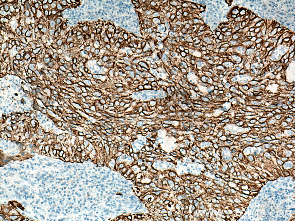 Immunohistochemistry (IHC) staining of human lung cancer tissue using Cytokeratin 19 Polyclonal antibody (14965-1-AP)