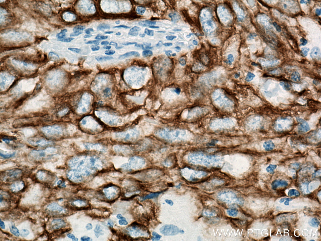 Immunohistochemistry (IHC) staining of human lung cancer tissue using Cytokeratin 19 Polyclonal antibody (14965-1-AP)