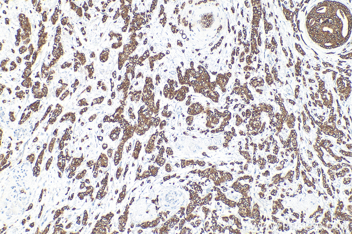 Immunohistochemistry (IHC) staining of human breast cancer tissue using Cytokeratin 19 Polyclonal antibody (14965-1-AP)
