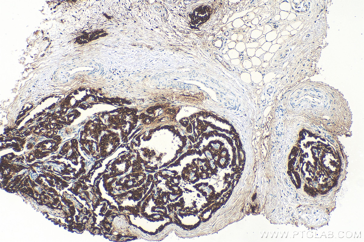 Immunohistochemistry (IHC) staining of human thyroid cancer tissue using Cytokeratin 19 Polyclonal antibody (14965-1-AP)