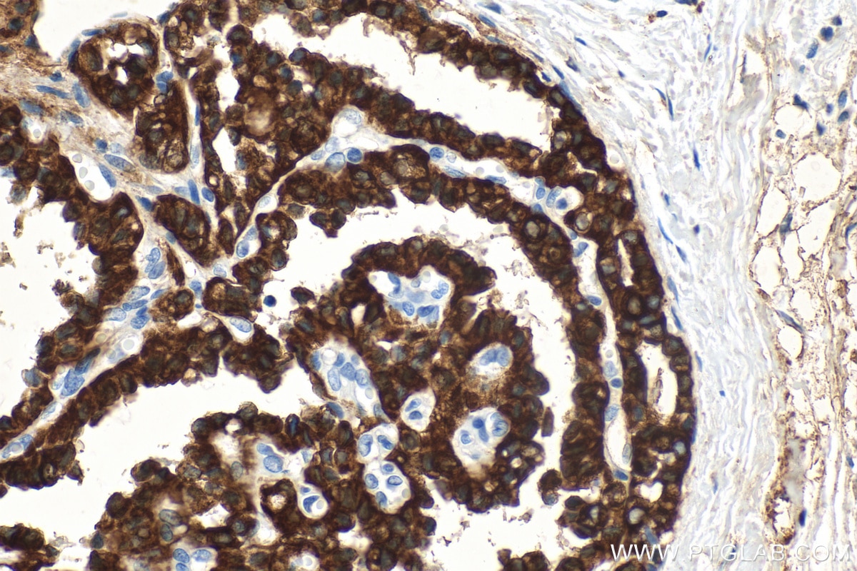 Immunohistochemistry (IHC) staining of human thyroid cancer tissue using Cytokeratin 19 Polyclonal antibody (14965-1-AP)