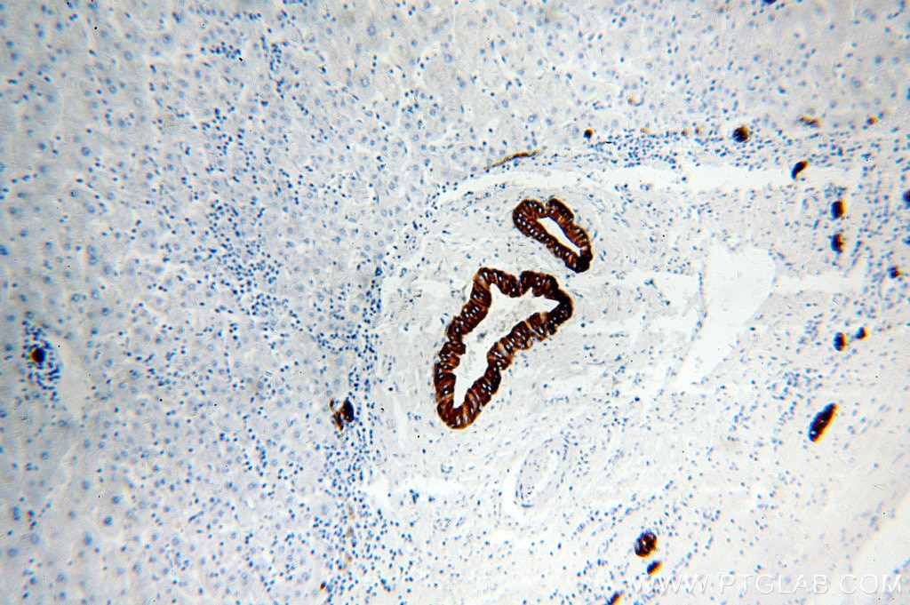 Immunohistochemistry (IHC) staining of human liver cancer tissue using Cytokeratin 19 Polyclonal antibody (14965-1-AP)