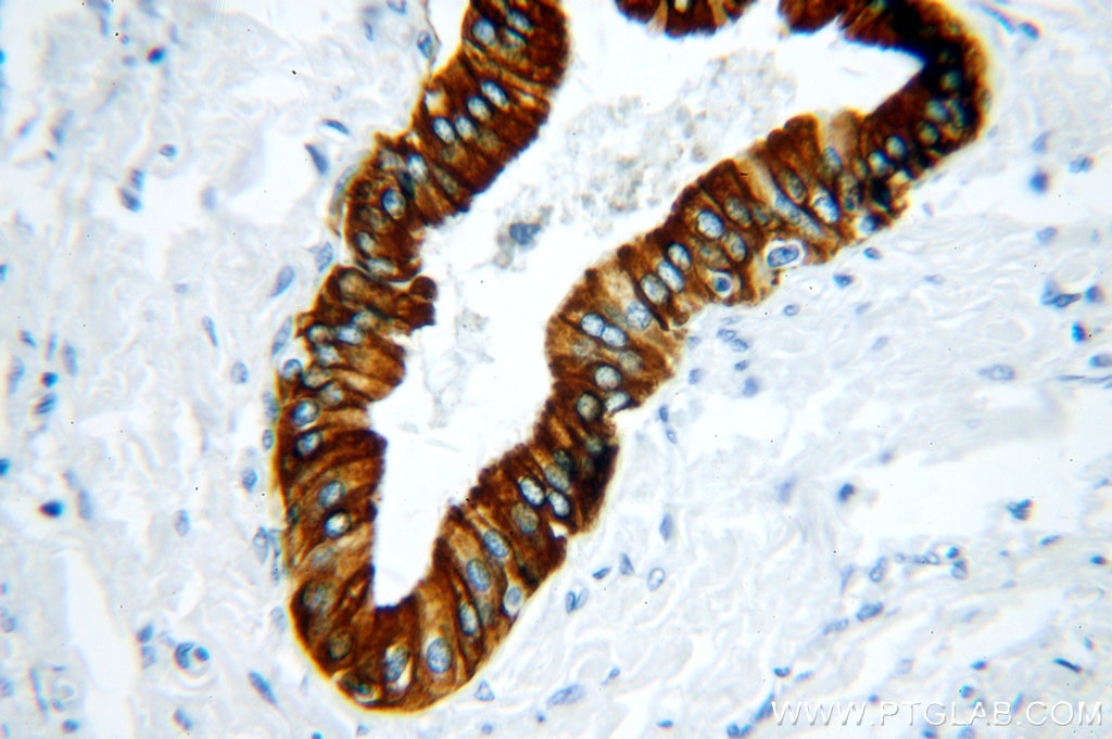 Immunohistochemistry (IHC) staining of human liver cancer tissue using Cytokeratin 19 Polyclonal antibody (14965-1-AP)