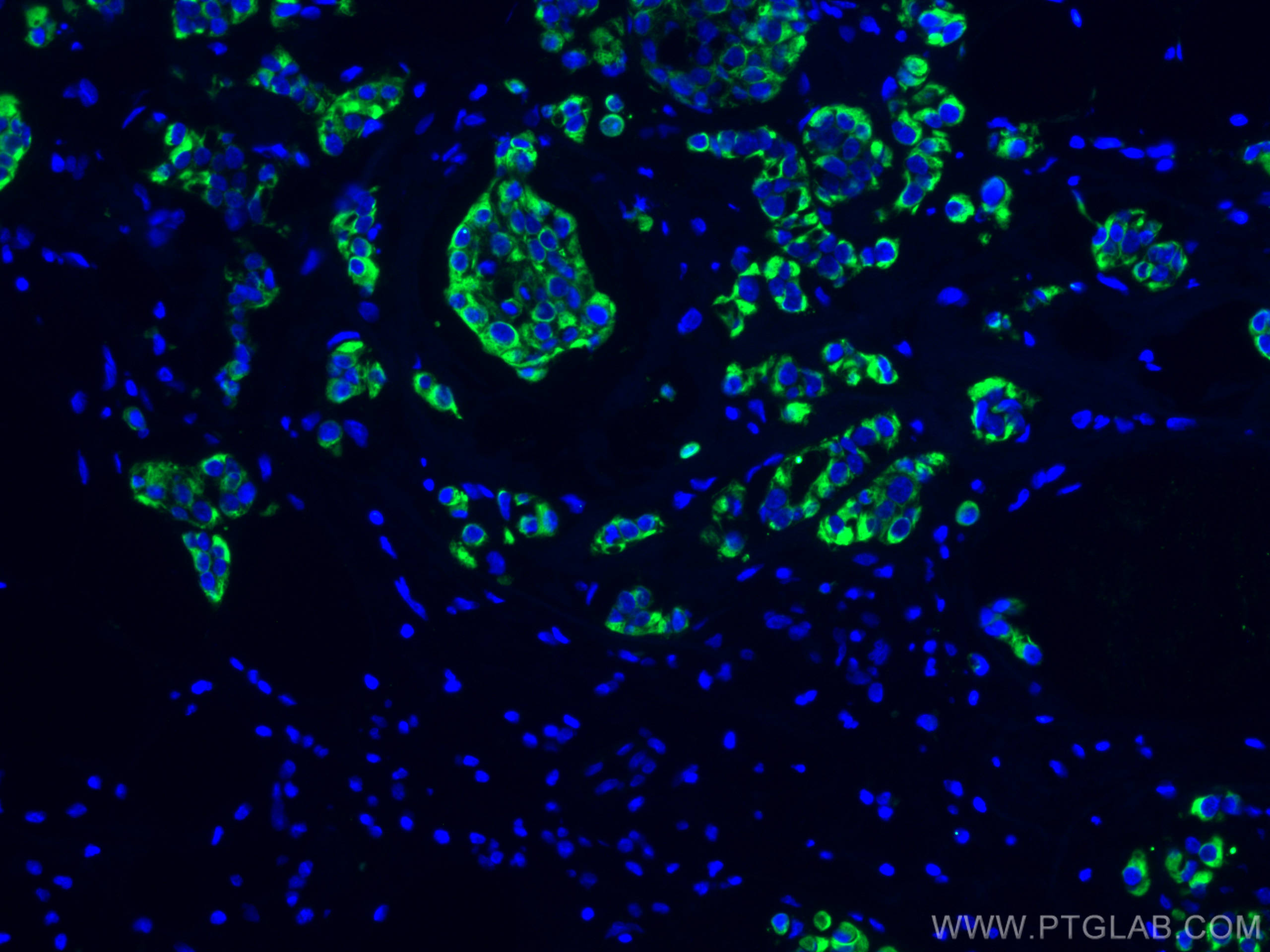 Immunofluorescence (IF) / fluorescent staining of human breast cancer tissue using Cytokeratin 19 Monoclonal antibody (60187-1-Ig)