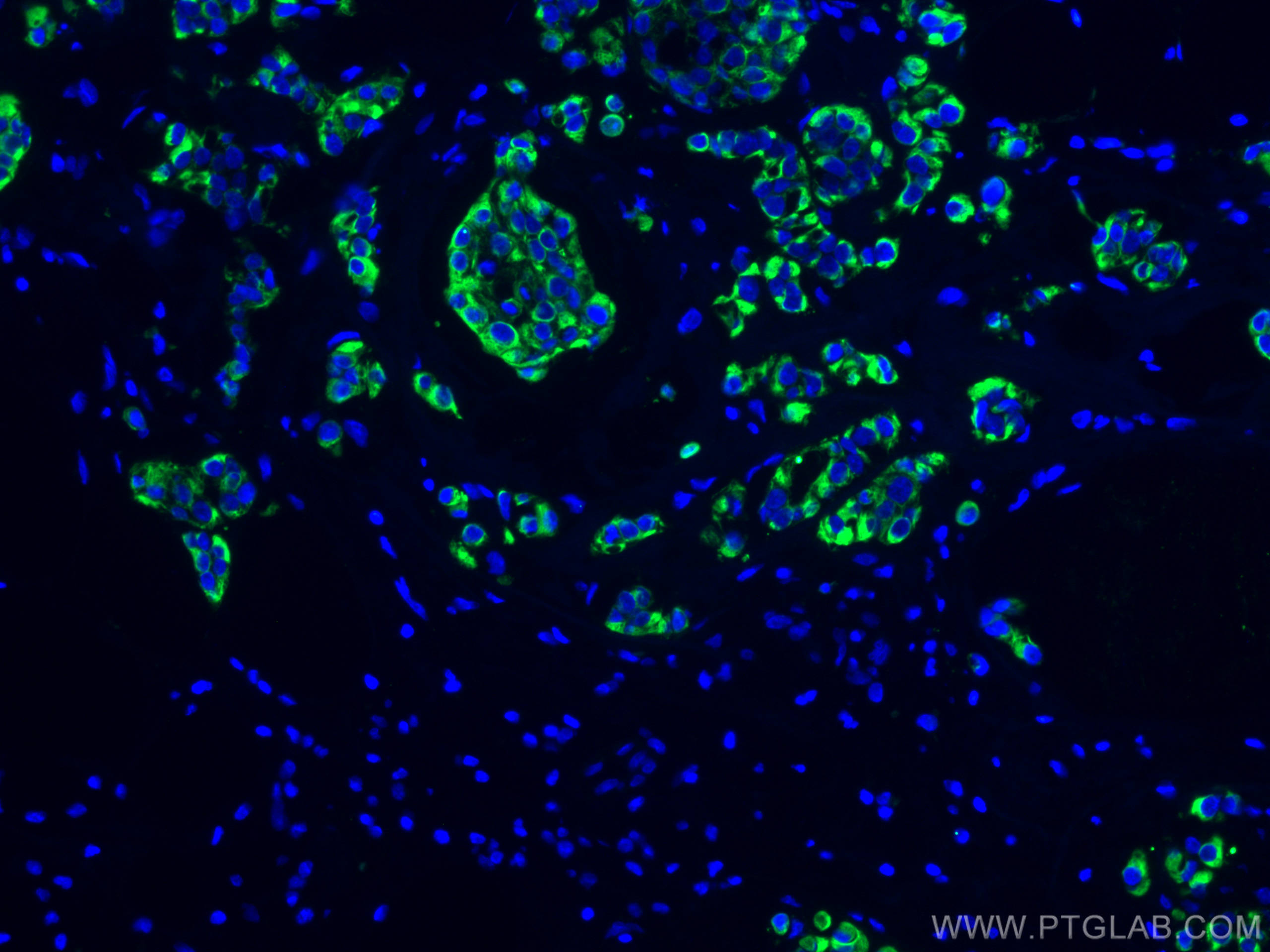 IF Staining of human breast cancer using 60187-1-Ig