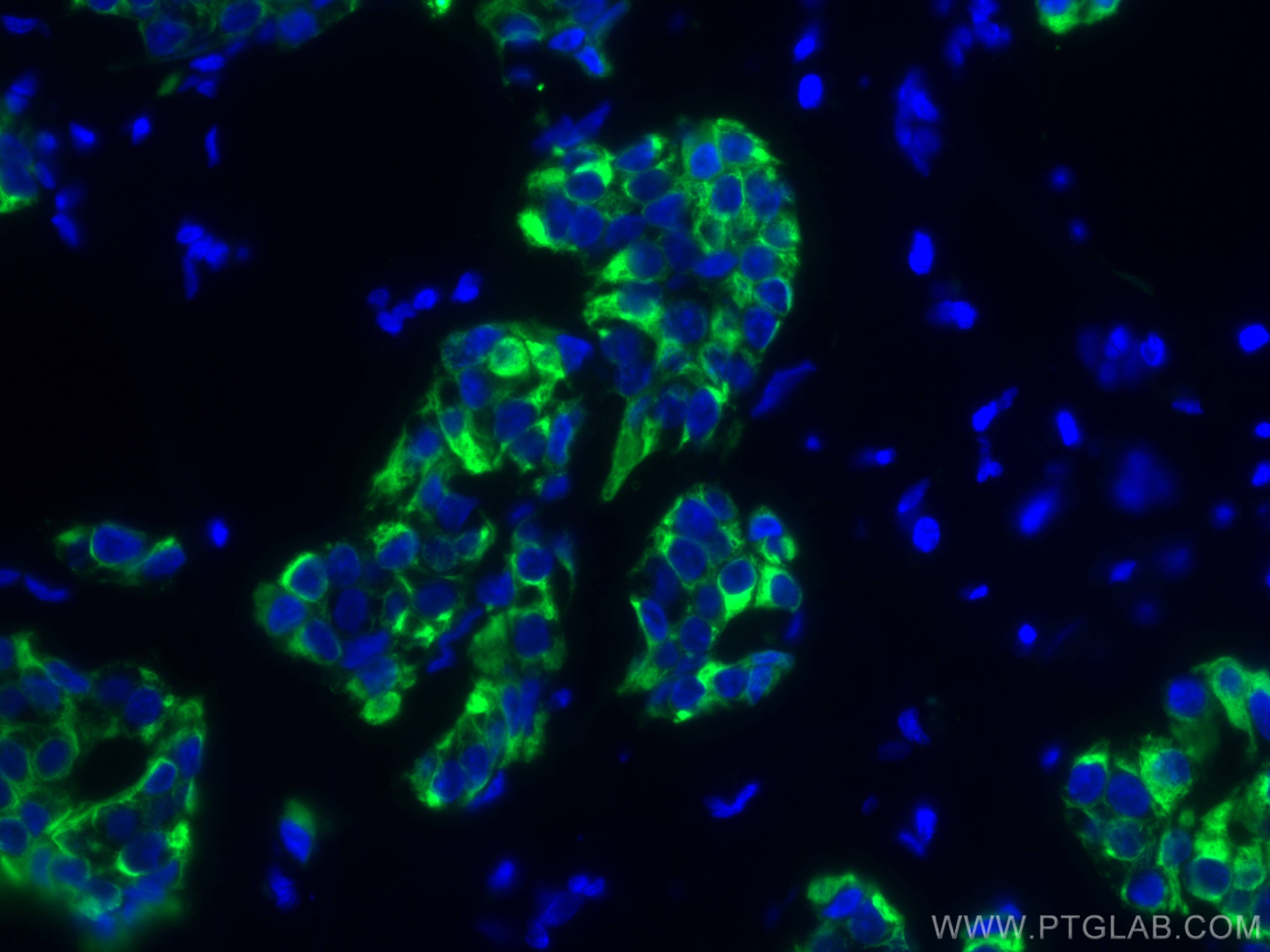 Immunofluorescence (IF) / fluorescent staining of human breast cancer tissue using Cytokeratin 19 Monoclonal antibody (60187-1-Ig)