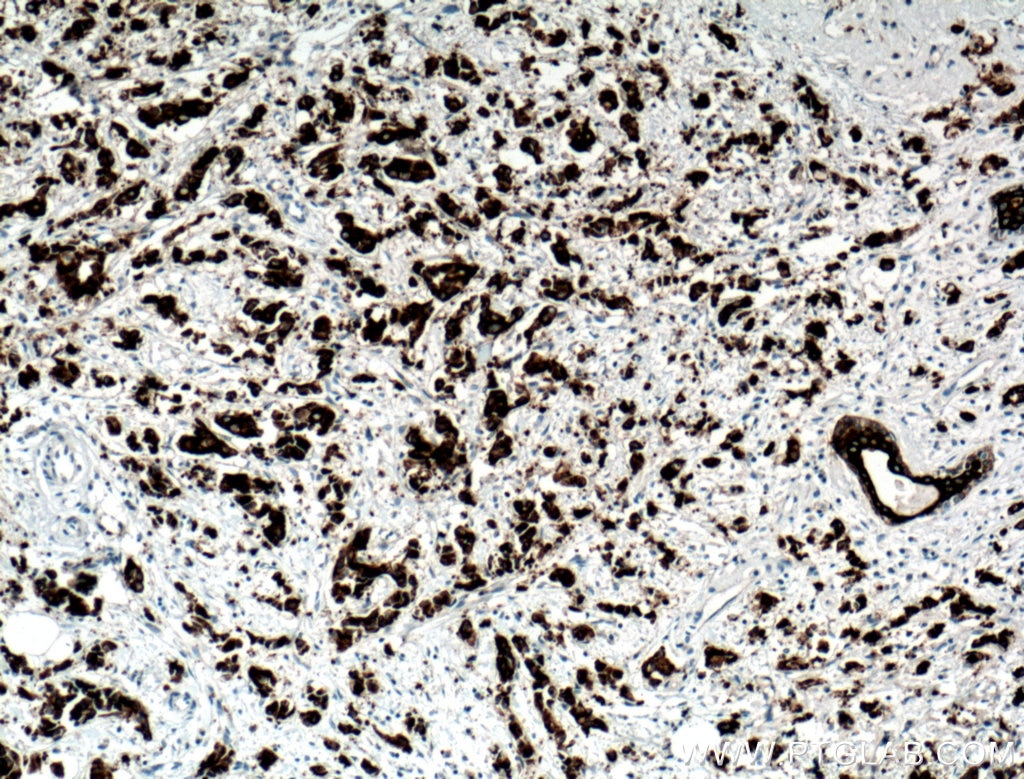 Cytokeratin 19