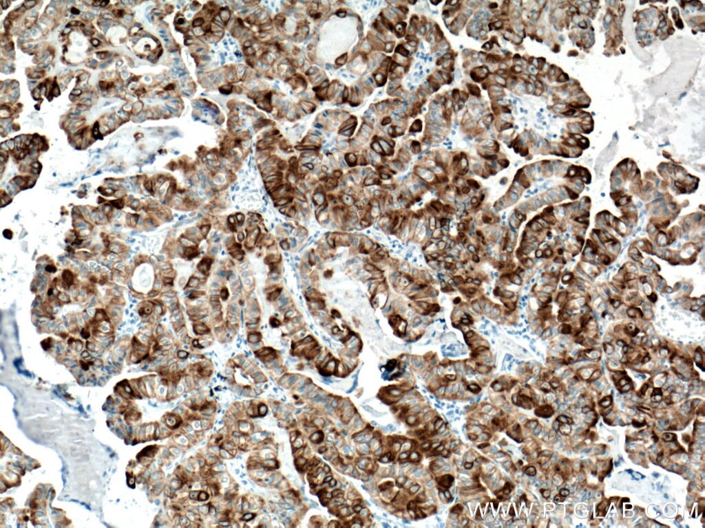Immunohistochemistry (IHC) staining of human thyroid cancer tissue using Cytokeratin 19 Monoclonal antibody (60187-1-Ig)
