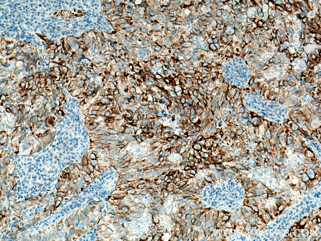 Immunohistochemistry (IHC) staining of human lung cancer tissue using Cytokeratin 19 Monoclonal antibody (60187-1-Ig)