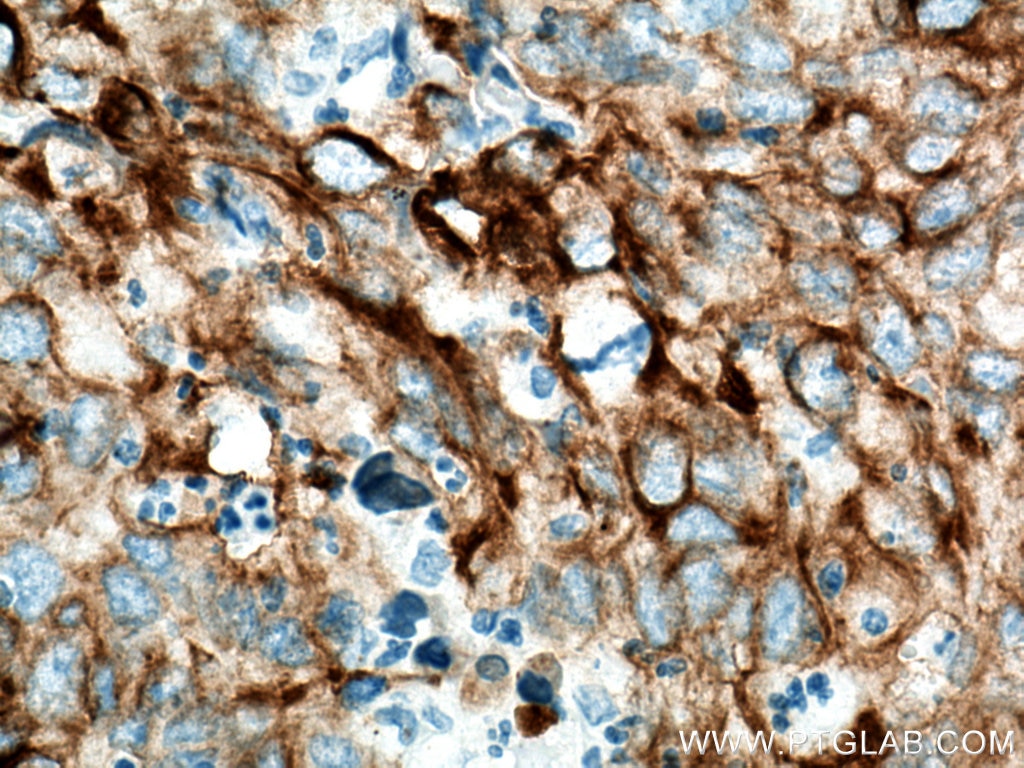 Immunohistochemistry (IHC) staining of human lung cancer tissue using Cytokeratin 19 Monoclonal antibody (60187-1-Ig)