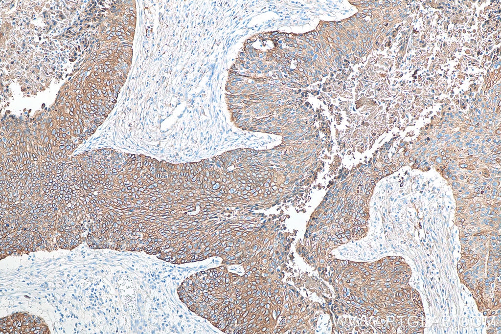 Immunohistochemistry (IHC) staining of human oesophagus cancer tissue using Cytokeratin 19 Monoclonal antibody (60187-1-Ig)
