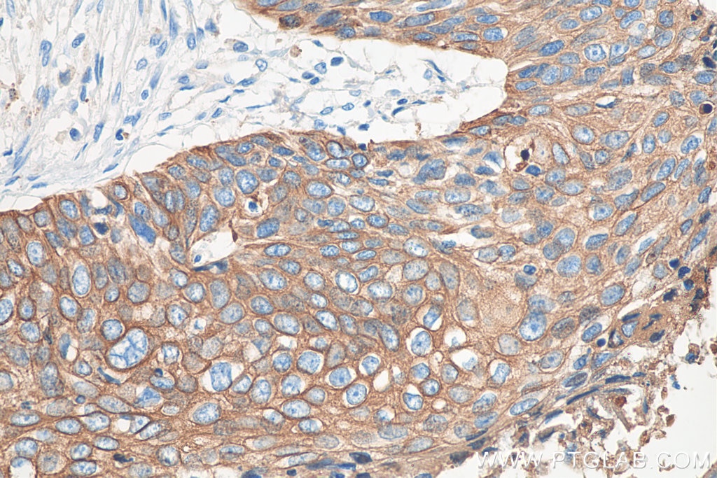 Immunohistochemistry (IHC) staining of human oesophagus cancer tissue using Cytokeratin 19 Monoclonal antibody (60187-1-Ig)