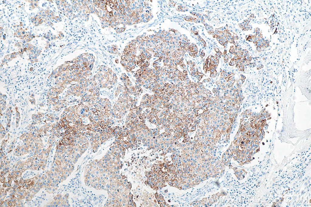 Immunohistochemistry (IHC) staining of human breast cancer tissue using Cytokeratin 19 Monoclonal antibody (60187-1-Ig)