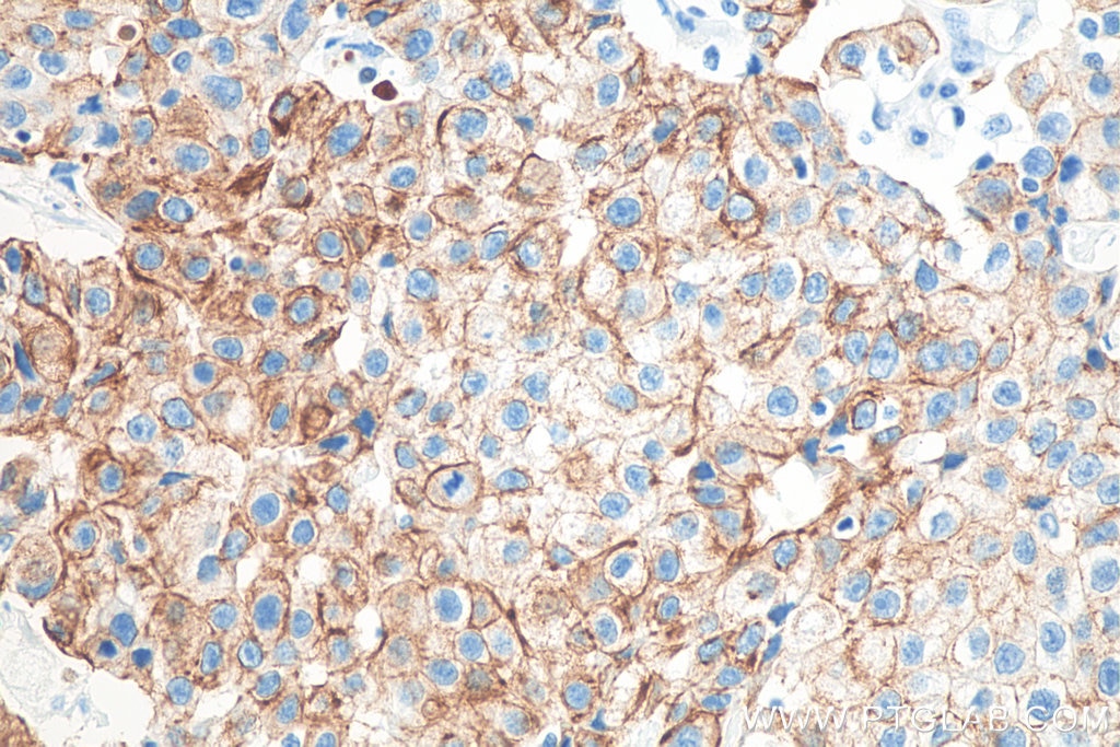Immunohistochemistry (IHC) staining of human breast cancer tissue using Cytokeratin 19 Monoclonal antibody (60187-1-Ig)