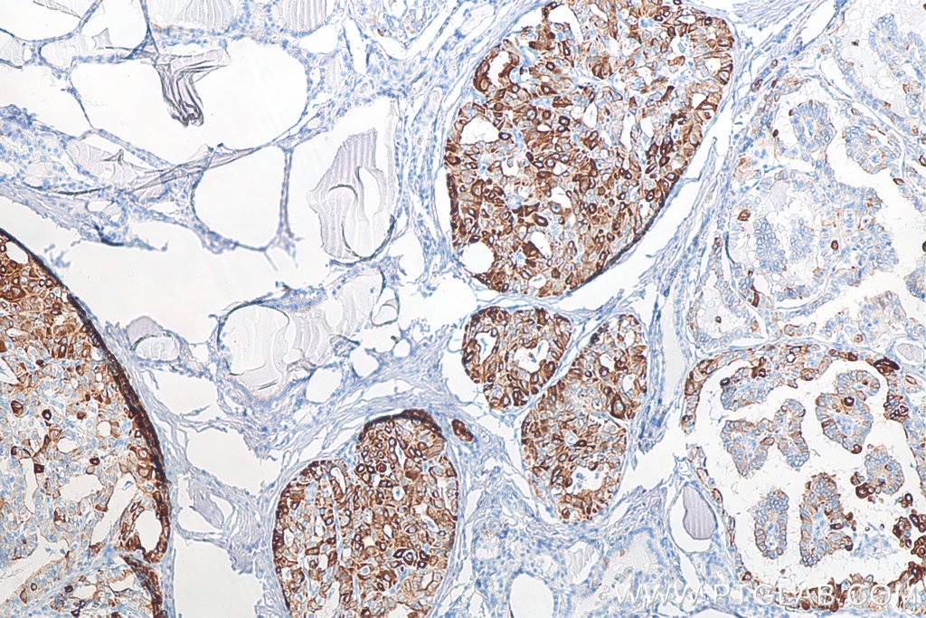 Immunohistochemistry (IHC) staining of human thyroid cancer tissue using Cytokeratin 19 Monoclonal antibody (60187-1-Ig)