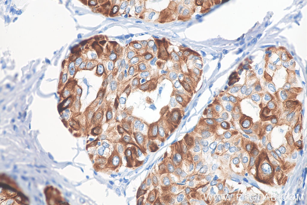 Immunohistochemistry (IHC) staining of human thyroid cancer tissue using Cytokeratin 19 Monoclonal antibody (60187-1-Ig)