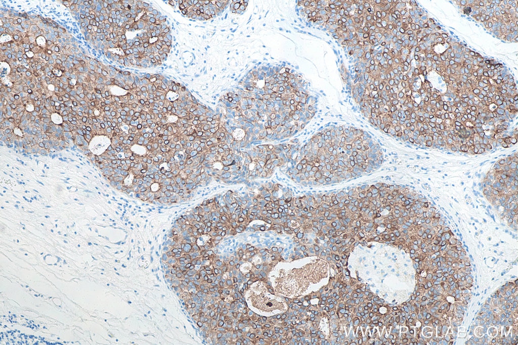 IHC staining of human breast cancer using 60187-1-Ig Immunohistochemistry (IHC) staining of human breast cancer tissue using Cytokeratin 19 Monoclonal antibody (60187-1-Ig)